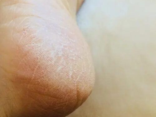 【口コミ】電動角質リムーバーを使ってみた|50代のガサガサかかと対策